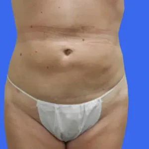 Tummy Tuck before and after photos Tummy Tuck before and after photos