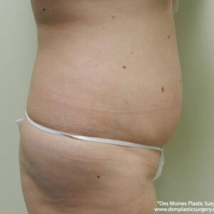 Tummy Tuck before and after photos