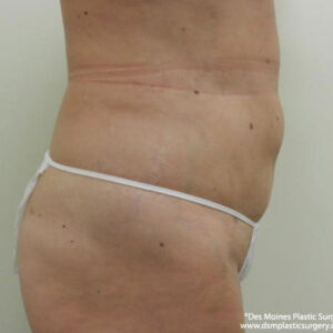 Tummy Tuck before and after photos