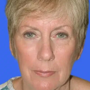 Face Lift before and after photos