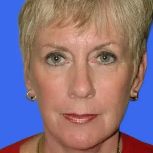 Face Lift before and after photos