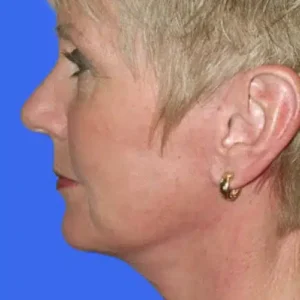 Face Lift before and after photos