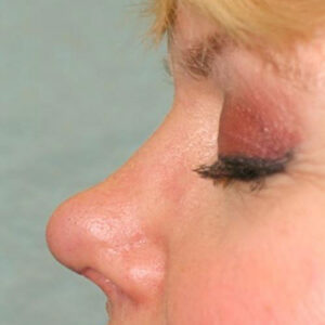 Rhinoplasty before and after photos