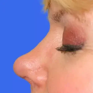Rhinoplasty