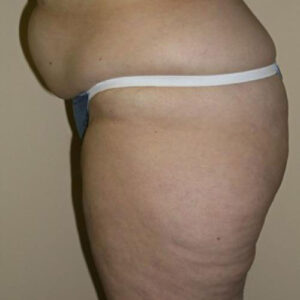 Liposuction before and after photos