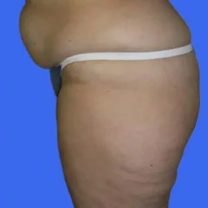 Liposuction before and after photos Liposuction before and after photos