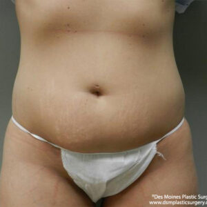 Tummy Tuck before and after photos