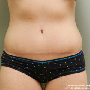 Tummy Tuck before and after photos