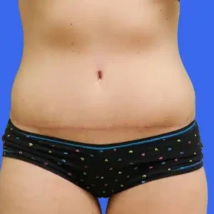 Tummy Tuck before and after photos Tummy Tuck before and after photos