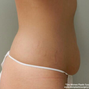 Tummy Tuck before and after photos