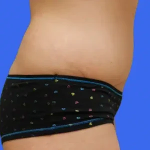 Tummy Tuck before and after photos Tummy Tuck before and after photos