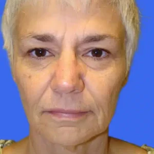 Face Lift before and after photos