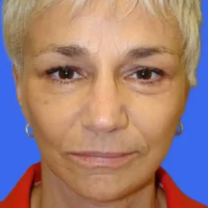Face Lift before and after photos