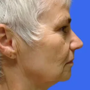 Face Lift before and after photos