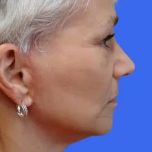 Face Lift before and after photos