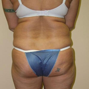 Liposuction before and after photos