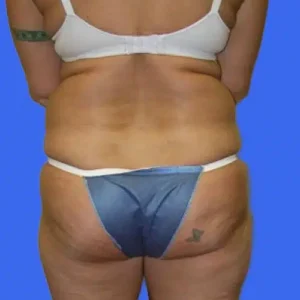 Liposuction before and after photos Liposuction before and after photos