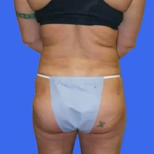 Liposuction before and after photos Liposuction before and after photos