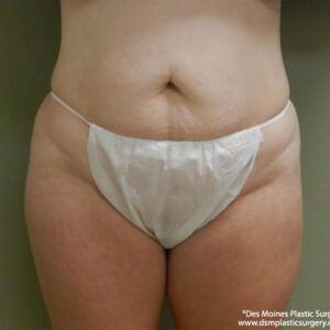 Tummy Tuck before and after photos
