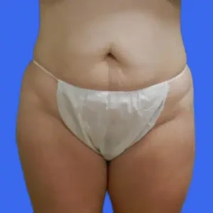 Tummy Tuck before and after photos Tummy Tuck before and after photos