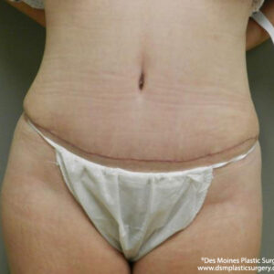 Tummy Tuck before and after photos