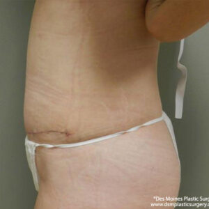 Tummy Tuck before and after photos