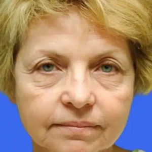 Face Lift before and after photos