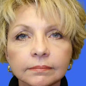 Face Lift before and after photos
