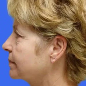 Face Lift before and after photos