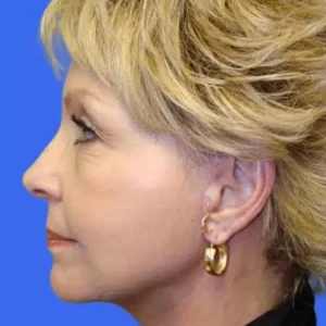 Face Lift before and after photos