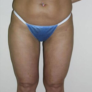 Liposuction before and after photos