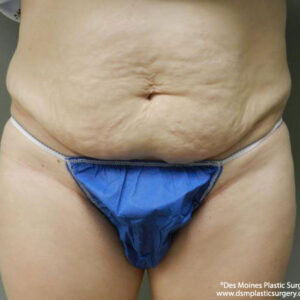 Tummy Tuck before and after photos