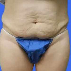 Tummy Tuck before and after photos Tummy Tuck before and after photos