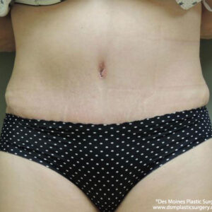 Tummy Tuck before and after photos