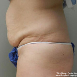 Tummy Tuck before and after photos