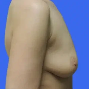 Breast Augmentation before and after photos Breast Augmentation before and after photos