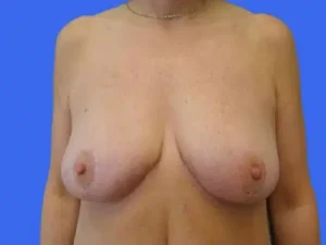 Breast Lift before and after photos Breast Lift before and after photos