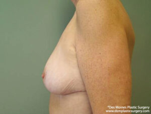 Breast Lift before and after photos