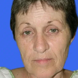 Face Lift before and after photos