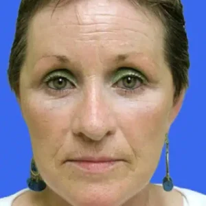 Face Lift before and after photos