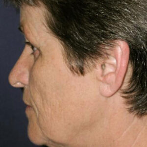 Face Lift before and after photos