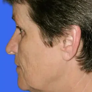 Face Lift before and after photos