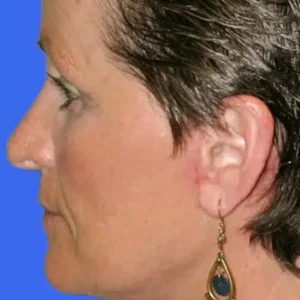 Face Lift before and after photos