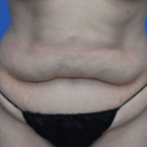 Tummy Tuck before and after photos