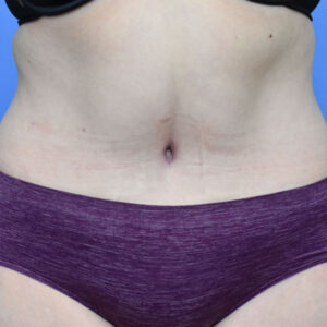 Tummy Tuck before and after photos