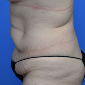 Tummy Tuck before and after photos