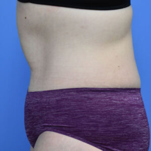Tummy Tuck before and after photos
