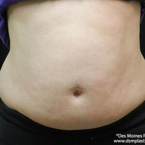 CoolSculpting before and after photos