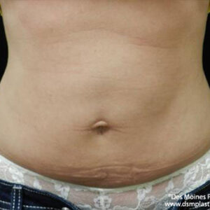 CoolSculpting before and after photos