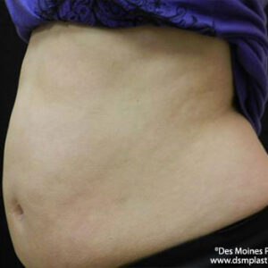 CoolSculpting before and after photos